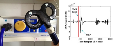 Transcranial Magnetic Stimulation (TMS) and Transcranial direct current stimulation (tDCS)